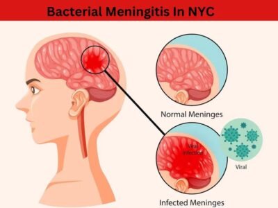 Bacterial Meningitis In NYC What You Need To Know